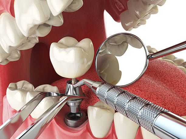 Best Emergency Denture Repair in Montclair, CA